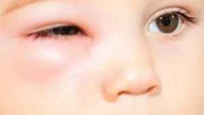 Паяк ухапване